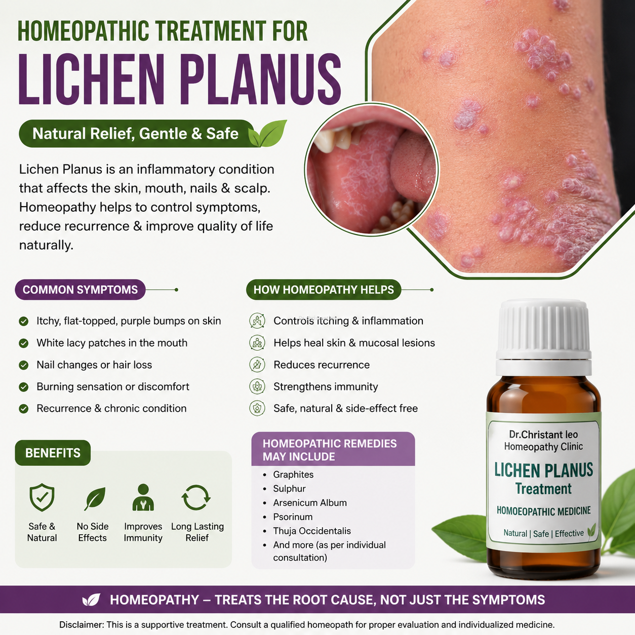 Spl homeopathy Lichen planus medicine